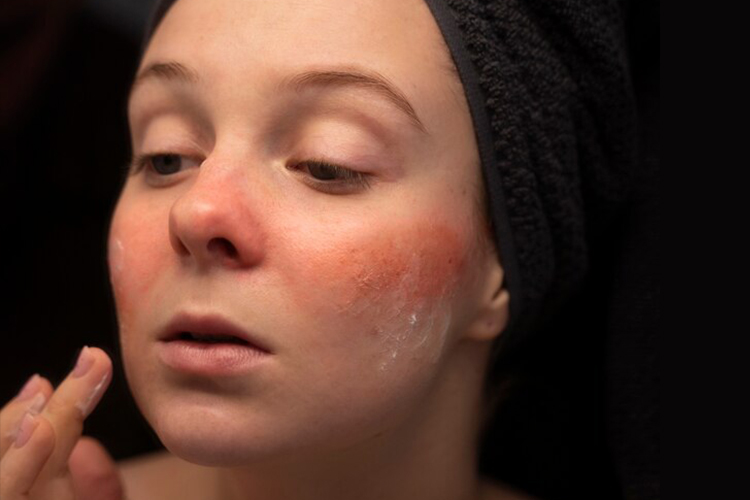 استفاده از محصولات تسکین دهنده و ضد آکنه